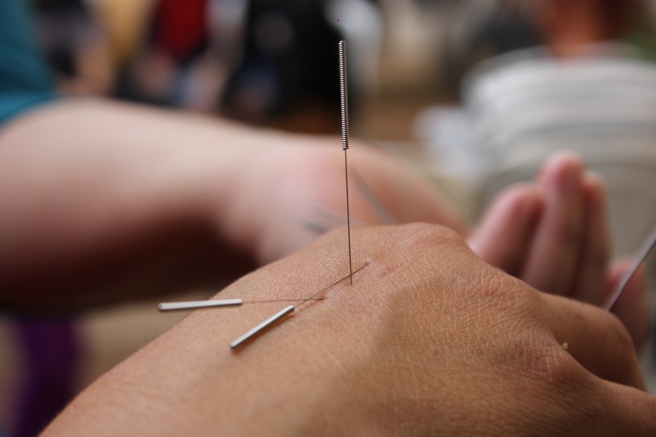 acupuncture-6324472_1280.jpg
