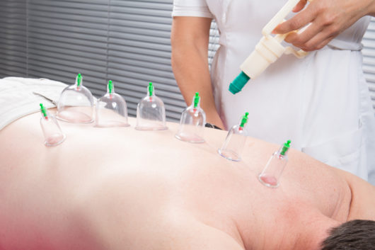 Cupping Therapy on a person's back