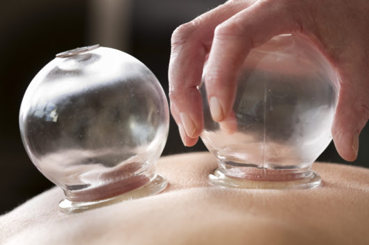 Cupping Therapy with Drug/Alcohol Rehab in San Diego