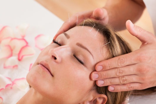 Acupuncture Therapy San Diego at Pacific Bay Recovery