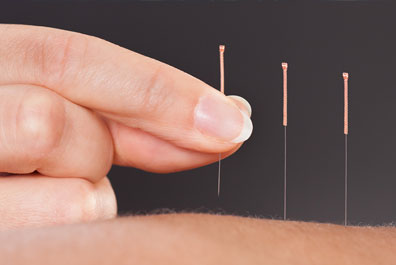 Acupuncture